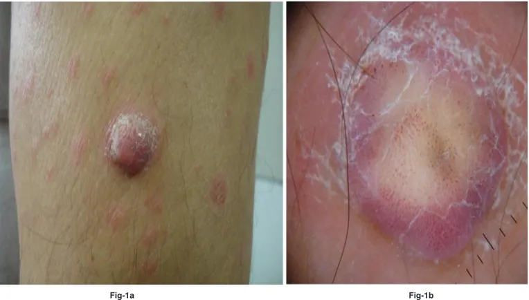 Figure 1a: A 2-cm, firm, pink exophytic nodule with a collarette scaling and erythematous, squamous papules on the left arm.