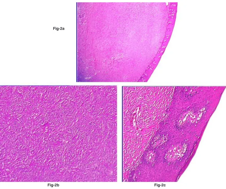 Figure 2a: The tumor infiltrates the whole thickness of the dermis with a narrow Grenz zone under the hyperplastic epidermis, H&amp;Ex12,5