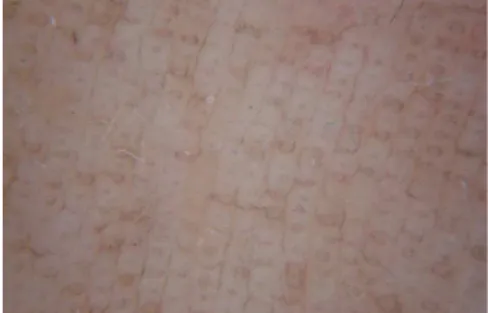 Figure 2: Numerous black circles in a paral- paral-lel pattern on the ridges of the skin markings  (documente by Dermlite foto)