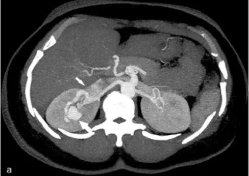 Figure 1. US image of the right kidney shows  anecoic cystic mass in the upper pole (arrow).