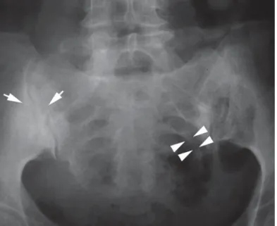 Figure 2. Coronal T1-weighted MR image shows a linear low signal intensity area (a, arrows),  with associated bone marrow edema on the left sacral wing and iliac bone on coronal FSEIR  image (b, arrows), which were found to be concordant with stress fractu
