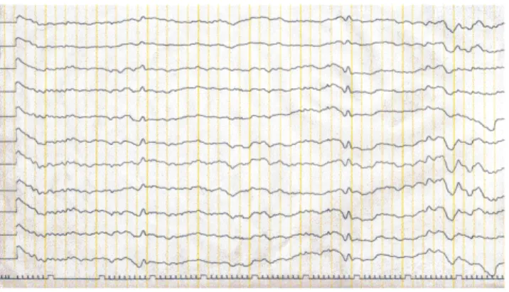 Figure 1. Electroencephalogram showing bilateral diffuse slow 