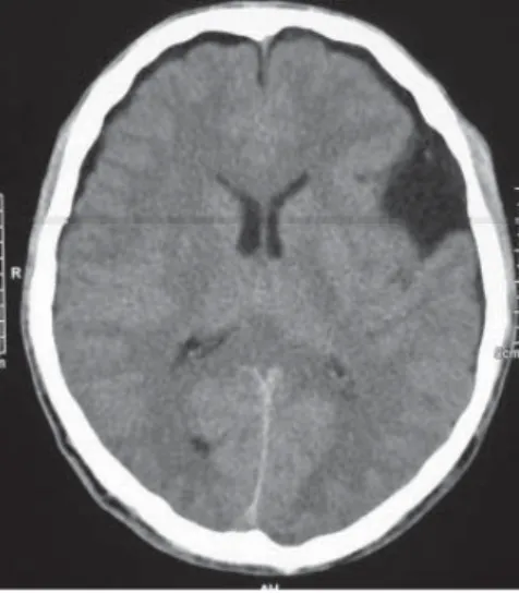 Figure 2. On a subsequent CT image, a left 