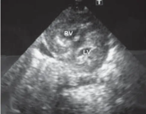 Figure 1. Parasternal short axis view showing 