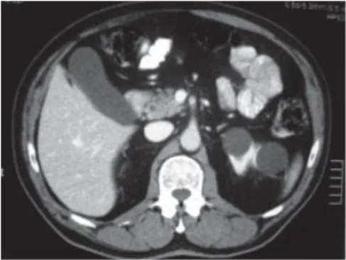 Şekil 1. Bilgisayarlı tomografide pankreas 
