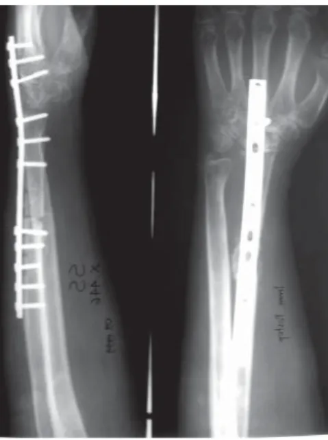 Figure 1. Preoperative X-Ray of the patient