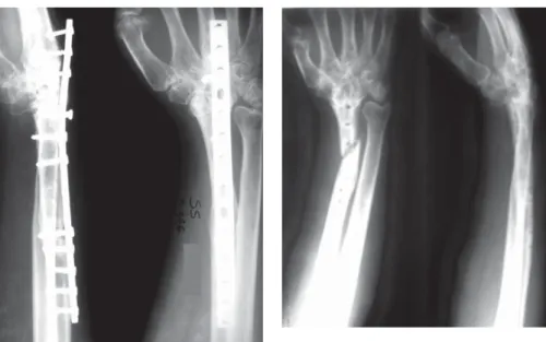 Figure 7. Postoperative x-ray of the patient 