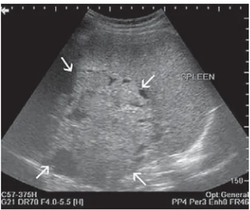 Şekil 1. Pankreatoblastom US görüntüsü.  Dalak medialinde kistik komponentler içeren  solid kitle lezyonu izleniyor (oklar).