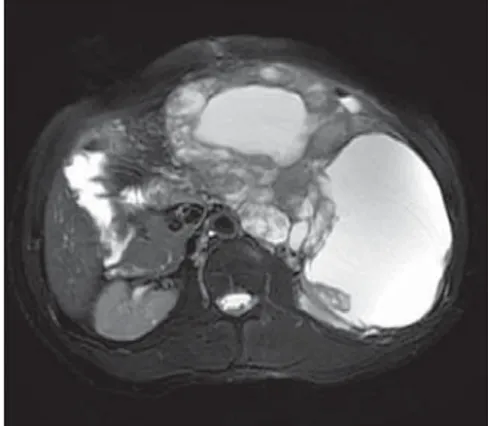Şekil 4. Pankreatoblastom aksiyal, yağ baskılı  T2 ağırlıklı MR görüntüsü. Kistik ve solid  kom-ponentlerden oluşan büyük boyutlu lezyonun  kistik komponentleri belirgin hiperintens  izle-niyor.