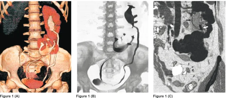 graphic  phase  acquired  with  2.5  mm  collimation  100  sec  after   ad-ministration of 100 cc of iodinated  contrast  agent   (Iodixanol,   Visi-paque 320 mgI/ml, GE Healthcare  Bio-Sciences, USA)  a rate of 3 ml/ sec  and  a  pyelographic  phase   ac-