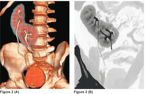 Figure 3. Oblique multiplanar reformatting image in the nephrographic phase  (A) and coronal volume rendering image in the delayed pyelograp- pyelograp-hic phase (B) show crossed fused renal ectopia with severe hydronephrosis