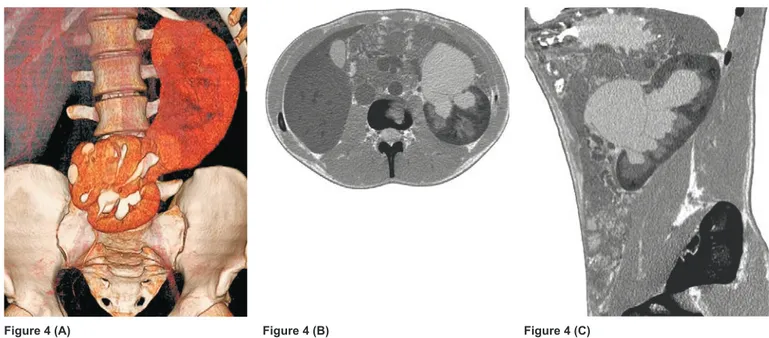 Figure 4. Coronal volume rendering image in the pyelographic phase  (A) shows crossed fused renal ectopia on the left side
