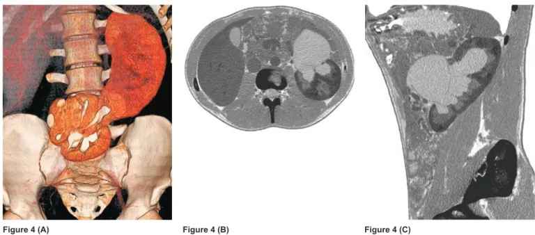 Figure 4. Coronal volume rendering image in the pyelographic phase  (A) shows crossed fused renal ectopia on the left side