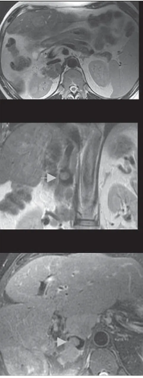 Figure 4. Both the parenchyma and the sinus  of the right kidney is invaded by HCC. On the  portal venous stage of the multiphasic MRI (A)  the contrast medium in the masses is washed  out (arrows)