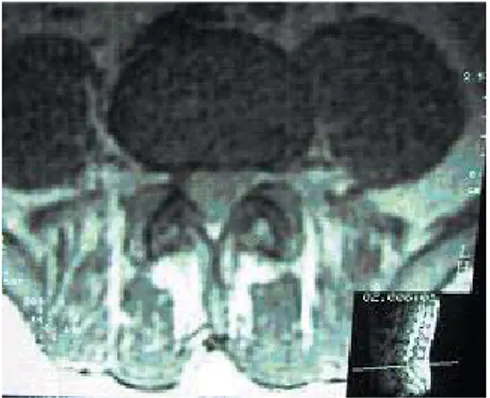 Şekil 4. Postoperatif 2. yılda yapılan kontrastlı  sagittal (a) ve aksiyal (b) MR  görüntülemeler-de nüks kitle lezyonu izlenmemektedir