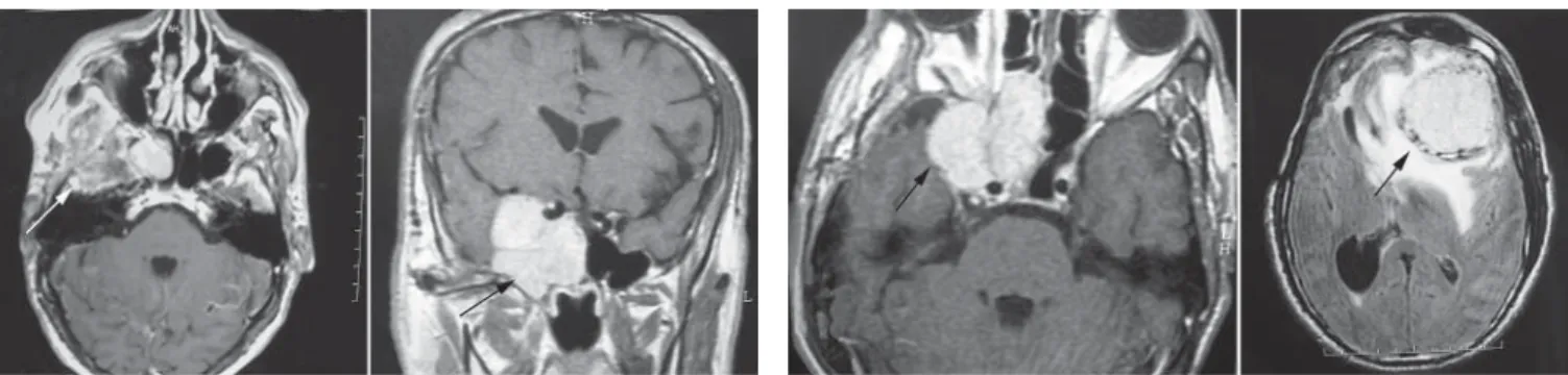 Figure 2A - 2B. Tumor recurrence can be seen at the same localization  (A). And a new mass detected in his control WRI (B) at the left frontal  lobe.