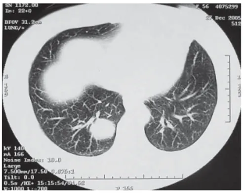 Şekil 2. Sağ akciğer alt lobdaki kitle lezyo- lezyo-nunun Toraks BT mediasten penceresindeki  görünümü