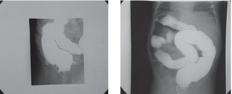 Figure 2: Voiding cystourethrography, oblique radiography reveals 