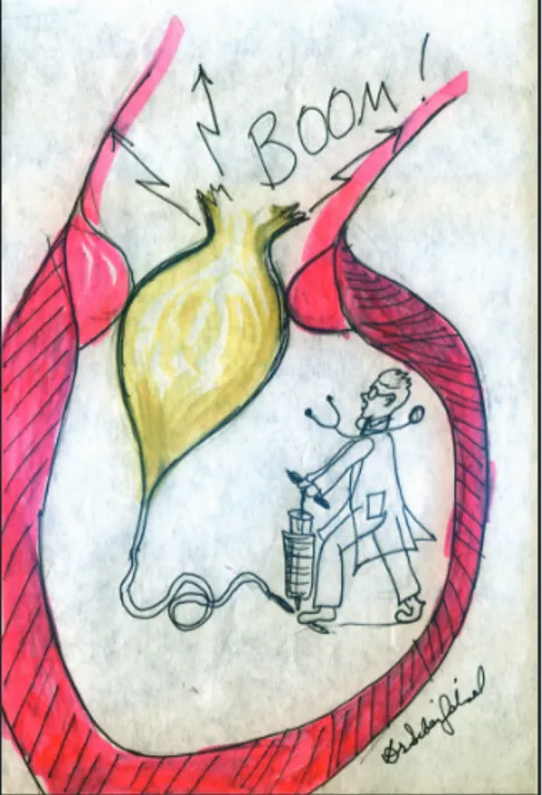 Şekil 7. Çizimde valvüloplasti yapan bir kardi- kardi-yolog  karikatürize edilmiş