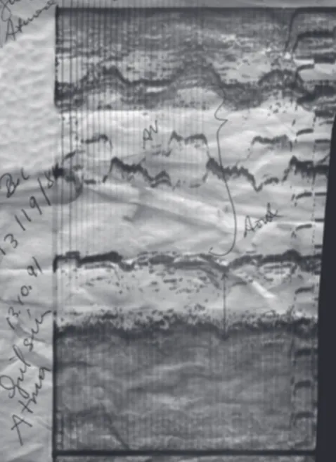 Şekil  4.  Kateter  sırasında  sol  ventrikülden  İndocyanin  green  verilerek  çekilen  Kontrast   Eko trasesi 1976