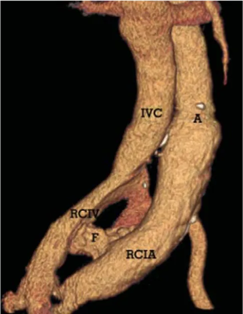 Figure 2A: Coronal oblique MIP image shows 