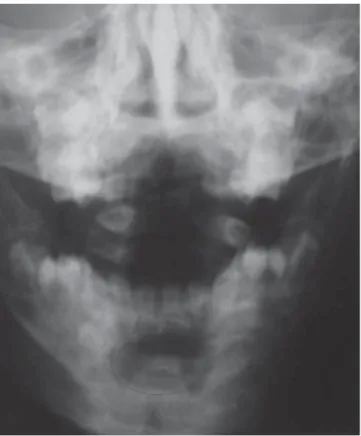 Şekil 2. Anteroposterior grafide korpus mandi-