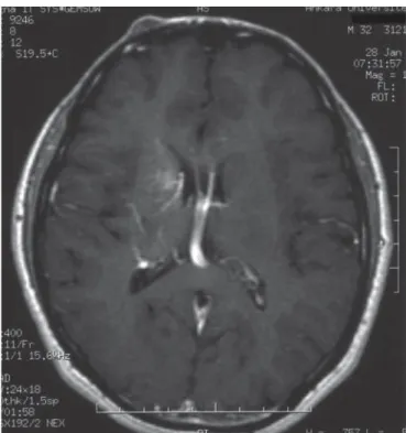 Şekil 6. T2 ağırlıklı sagittal MR görüntüsünde bazal ganglionlar seviye- seviye-sinde hemosiderin birikimine ait periferik hipoekoik halo ve tipik  “pop-corn” görünümüyle kavernöz anjiyom izleniyor.