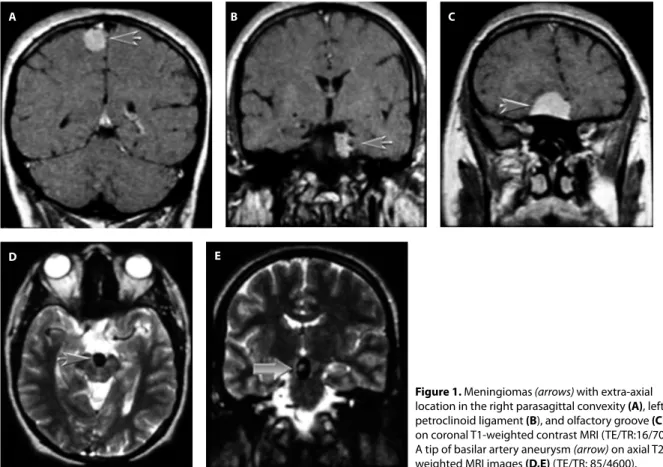 Figure 1. Meningiomas (arrows) with extra-axial 