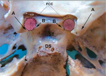 Şekil 1. İnkomplet tip foramen caroticoclinoidale; FCC: foramen 