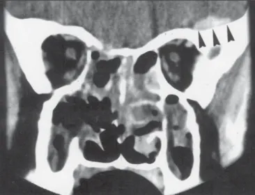 Figure 3. Polipoid mass in the paranasal sinuses and nasal cavity with 