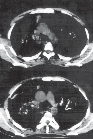 Figure 4. Irregular cavitary and solid lesions in both lung parenchyme. 