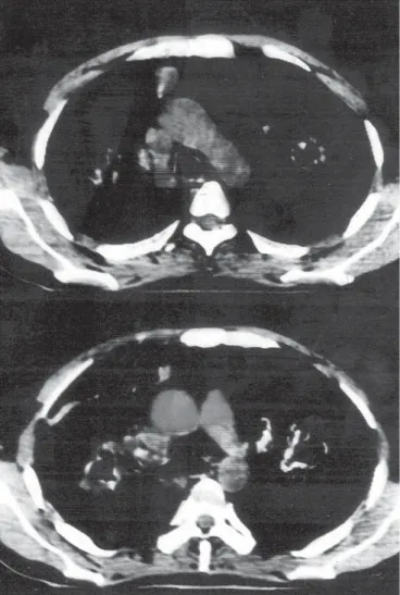 Figure 4. Irregular cavitary and solid lesions in both lung parenchyme. 