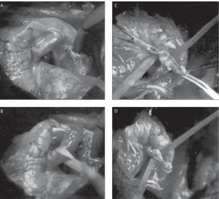 Figure 1. Intraoperative photograph showing aortico-right atrial tunnel (the patient’s head is on the lower end); (A) A systolic thrill is verified by palpation,  (B) blunt dissection is used for posterior tunnel attachments, avoiding injury to right coron