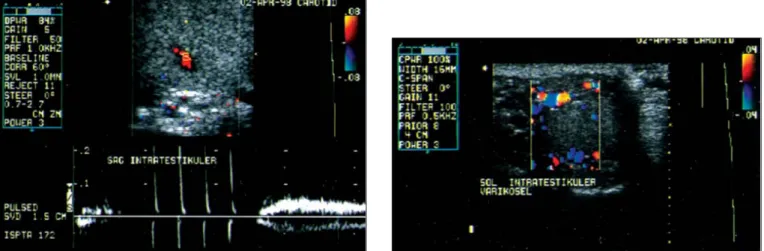 Şekil 3 ve 4. Hastanın SRDUS tetkikinde sağ ve sol internal spermatik vende reflü izlenmektedir.