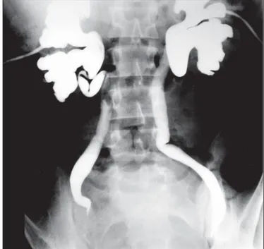 Figure 1. Non-contrast CT image of huge pelvic hytadid cyst. 