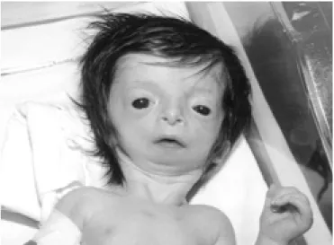 Figure 2. Typical facial appearance of Treacher Collins syndrome from the site.