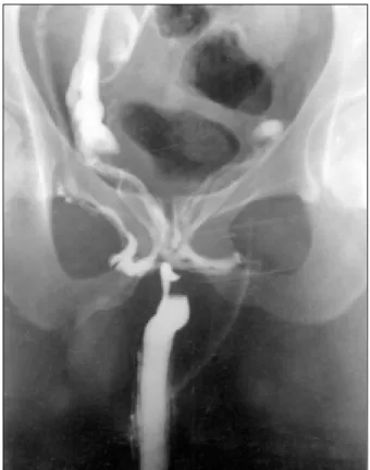 Figure 2. Antegrade urethrogram showes a 2 cm urethral filling 
