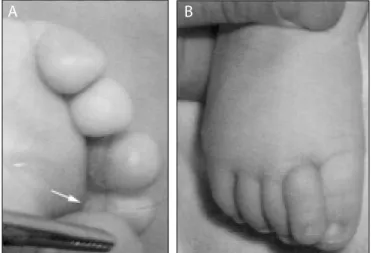 Şekil 2. (A) Üçüncü ayak parmağındaki ülserasyonun görünümü. Ok 