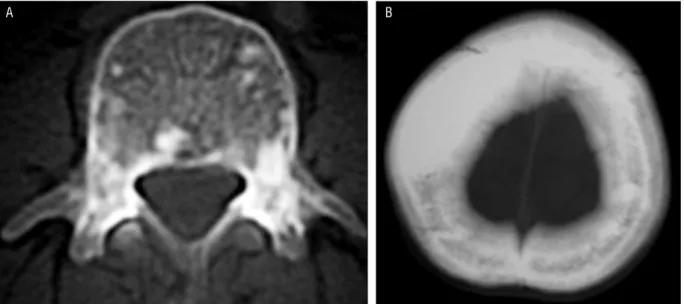 Şekil 3. BT’de kemik pencerede, lomber vertebra korpusunda (A) ve verteks düzeyinde parietal kemikte (B) osteosklerotik lezyonlar görülüyor.