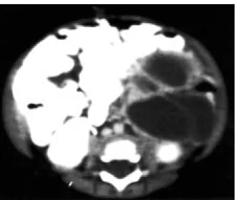 Figure 1. Computed tomography scan of abdomen shows a large 