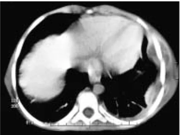 Figure 1A. Axial CT scan shows left upper lobe abscess and costal 
