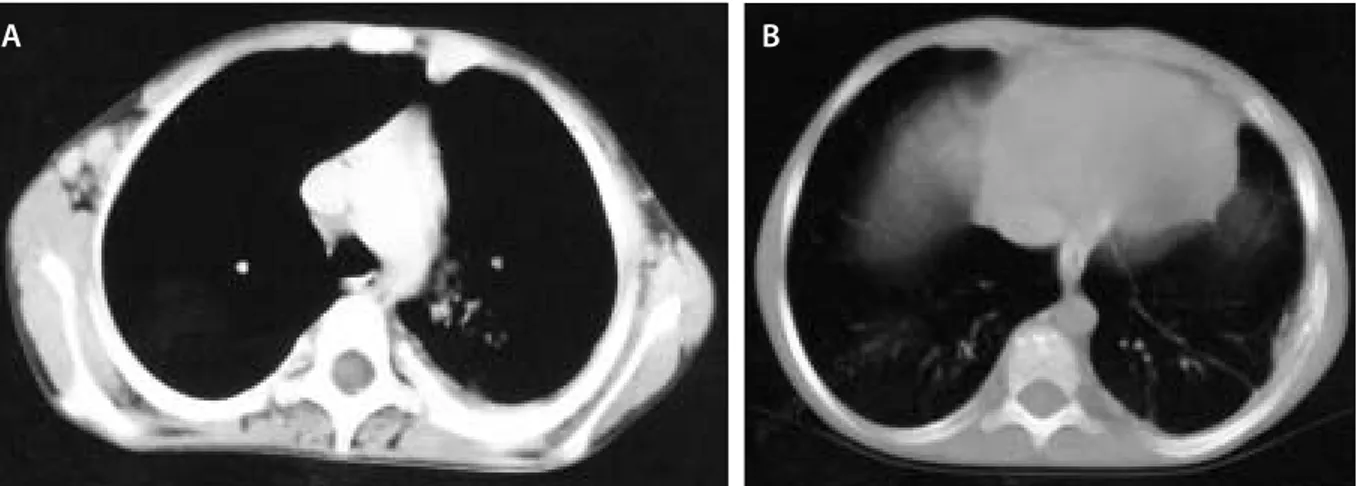 Figure 2. A ve B. Follow up CT scans of the same levels reveal nearly complete regression of the soft tissue lesions of the chest wall (a)