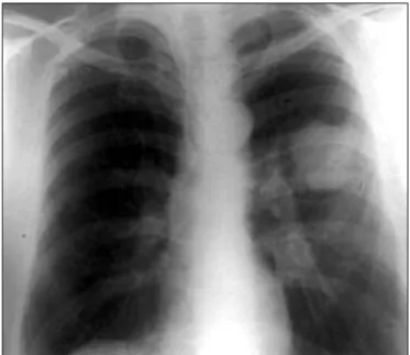 Figure 3. CT of the mass in the left lower lobe.