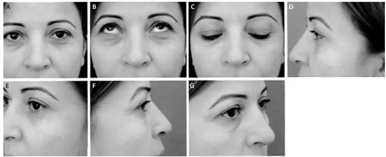 Figure 4. Standard  views for  blepharoplasty