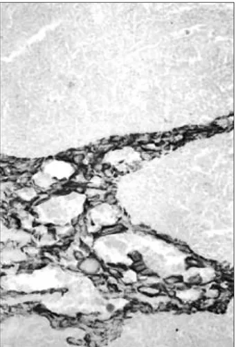 Fig. 2. LMW-CK positivity within the tumoral areas of the metastatic lymph 