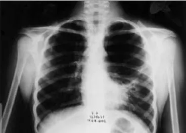Figure 1. Preoperative chest X-ray, showing a large lucent area of the left 