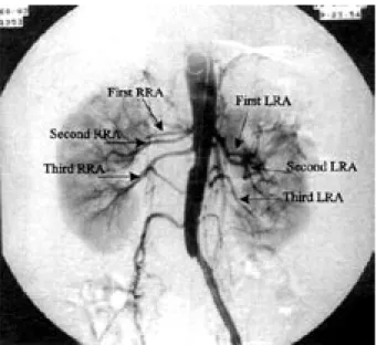 Figure 1. Preoperative DSA showing occlusion of the right common  iliac, celiac, superior- inferior mesenteric arteries and bilateral triple renal  arteries