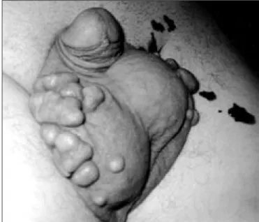 Fig. 2.  Amorphous calciﬁed deposits in large ﬁbrotic areas (HE, × 40)