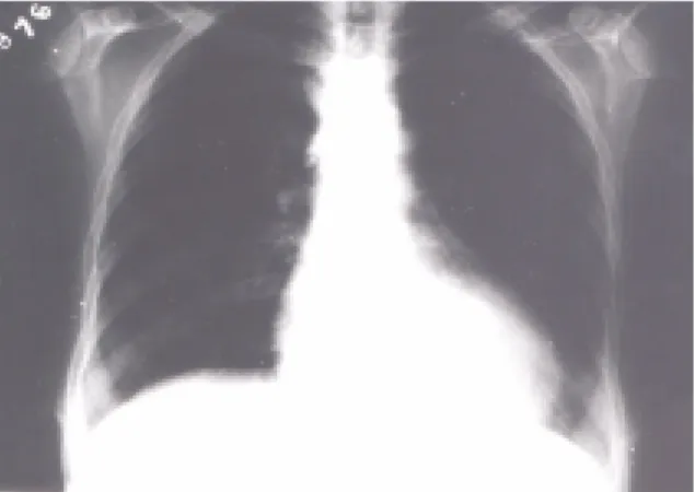 Şekil  4:  Postoperatif    göğüs  röntgenogramında  kalp gölgesinin küçüldüğü görülmektedir.