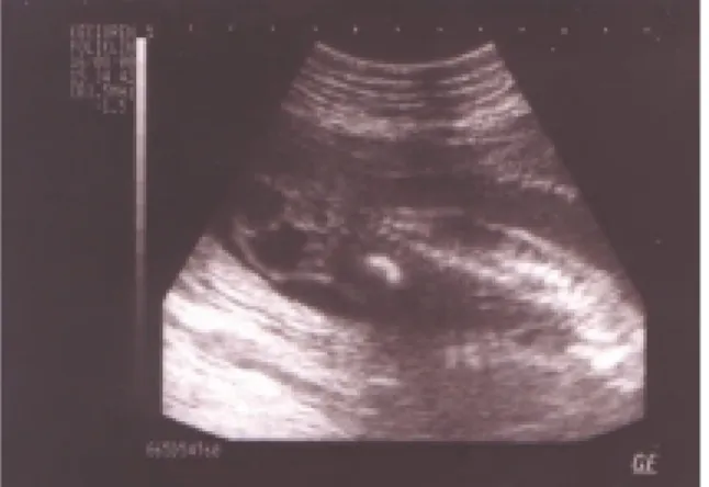 Şekil 2: Sakrokoksigeal teratomlu bebeğin resusitasy- resusitasy-on sresusitasy-onrası fotografı